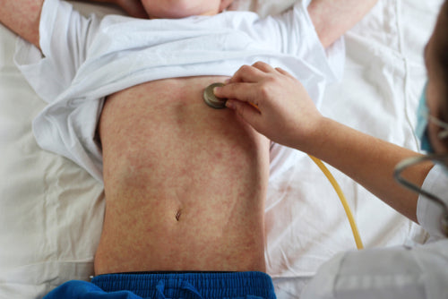 doctor caring for child with measles
