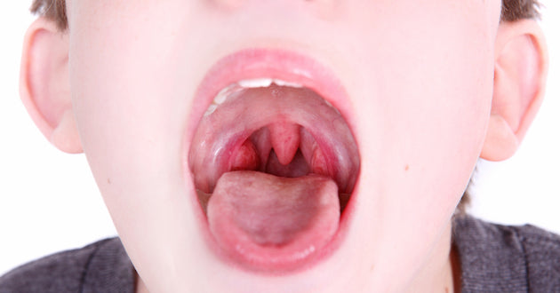 Should Kids' Tonsils Be Removed?