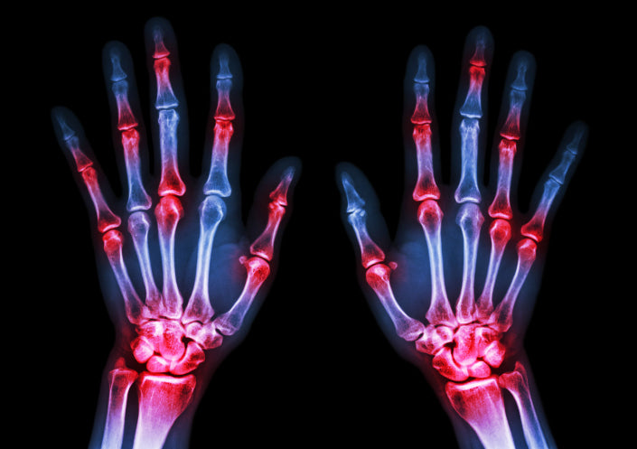 arthritis at multiple joint of hands,Gout,Rheumatoid